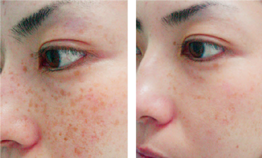 A woman with brown spots on her face and the eye.